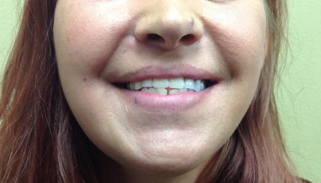 Upper Denture After